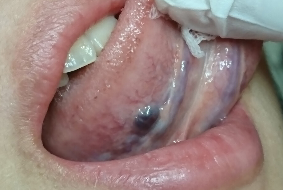 舌　血管腫