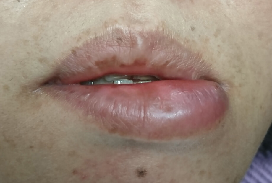 下唇部良性腫瘍